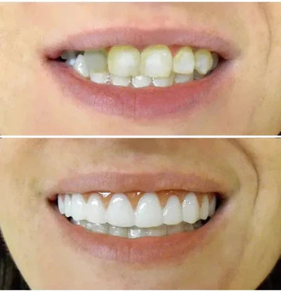 Dentadura Universal NewSmile | Seu Sorriso Vale Ouro