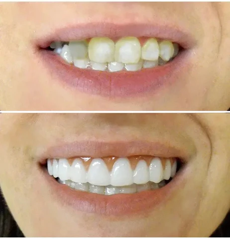 Dentadura Universal NewSmile + Clareador Dental de Fórmula Inovadora V.34 de BRINDE